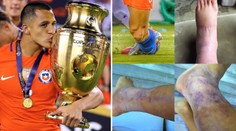 Tohle je můj kotník! Superstar z Arsenalu vyděsila fanoušky