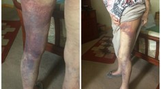 Lupič přepadl babičku (92) kvůli stovce! Utrpěla děsivá zranění