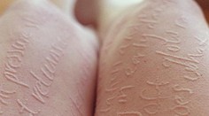 Tělo jako umělecké dílo: Žena se vzácnou nemocí má kůži jako malířské plátno