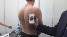 Melanomů v Česku přibývá. Lidé by neměli podcenit lékařskou kontrolu