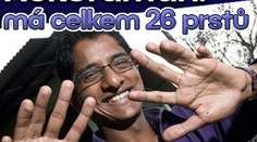 Rekordman: má celkem 26 prstů