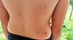 Štěnice pokousaly děti na letním táboře na Děčínsku. Řeší to hygiena