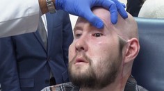 Ojedinělý úspěch amerických lékařů. Provedli první transplantaci celého oka