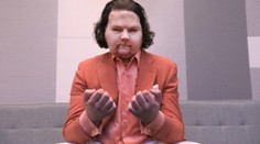 Mladík přišel o tvář i ruce. Lékařům se poprvé povedlo transplantovat obojí