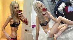 Ellen (19) vážila jen 35 kilo, od smrti ji dělily minuty! VIDEO