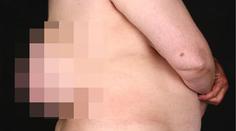 Ženě vyrostlo na zádech "třetí prso"! Nechala ho růst 10 let