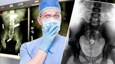 Šílená GALERIE: Tohle všechno už doktoři našli lidem v žaludku!