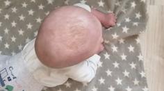 Obří boule na hlavě ničí miminku život. Ortézu pojišťovna neproplatí
