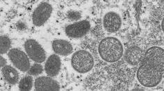 Opičí neštovice se šíří dál. Dle mikrobiologa Hořejšího jsou ale málo nakažlivé