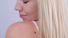 Dermatolog lidem radí metodu ABCDE. Mohou díky ní odhalit rakovinu kůže
