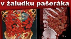 Pašerák měl v žaludku 72 balíčků kokainu