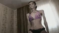 Dívka (23) přestala jíst po rozchodu! Nyní váží už jen 21 kilo