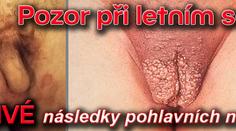 Pozor při letním sexu: DĚSIVÉ následky pohlavních nemocí