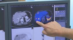 Lékař varuje před přehlíženou rakovinou. Jeden symptom nesmíte ignorovat
