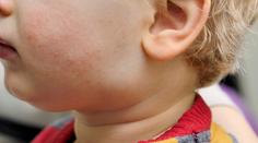 V Česku se šíří příušnice. Pacientů je víc než za posledních pět let dohromady