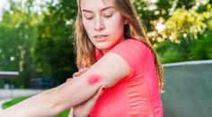 Co dělat po bodnutí hmyzem nebo vyndání klíštěte? Dermatoložka řekla, kdy vyhledat lékaře