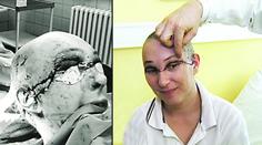 Paní Petře z Plzeňska skalpoval kůži vrták! Lékaři dokázali zázrak