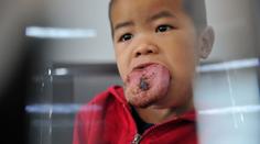 Má třikrát větší jazyk! Malý chlapec (4) nemůže ani jíst