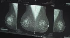 Případů rakoviny přibývá, čísla jsou alarmující. Lidé podceňují preventivní prohlídky