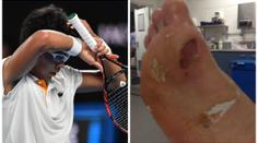 Tohle nešlo dohrát! Čong Hjon po skreči s Federerem ukázal puchýř