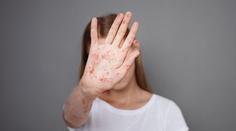 Epidemie spalniček na vzestupu. Kdo je nejvíc v ohrožení?