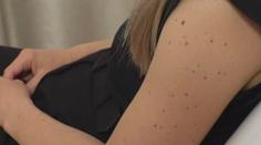Prevence rakoviny kůže: Při samovyšetření pomůže pravidlo ABCDE, radí dermatoložka