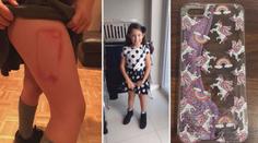Olivia (9) bude mít celý život hroznou jizvu! Kvůli pouzdru na mobil