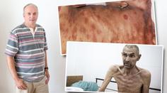 Pravá tvář AIDS: Muž promluvil o utrpení umírajících! SVĚDECTVÍ