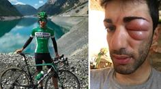 Cyklista se po štípnutí změnil v monstrum! Překvapila ho alergie