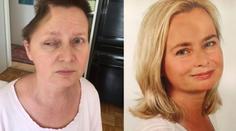 Dovolená v Česku jí zničila život i vzhled. Ženě (52) odstranili část lebky