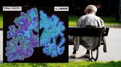 Tajemství Alzheimera? Vědci už ví, která látka nemoc rychle zhoršuje