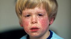 Epidemie spalniček má jednoho viníka. Stopy vedou do Ruska