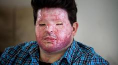 Chtěl pomstít příbuzného a polil muže kyselinou. Spletl si ale dům