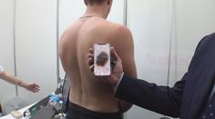 Melanomů v Česku přibývá. Lidé by neměli podcenit lékařskou kontrolu