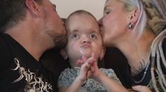 Emilek (3) trpí vzácným syndromem. Deformuje mu lebku, má za sebou spoustu operací