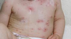 V Evropě jsou opičí neštovice! Vakcína není, lékaři děsí pandemií