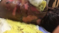Máma nemůže své dítě obejmout! Chlapeček trpí, ztratil většinu kůže