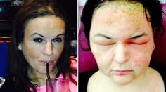 Spálená kůže, hlava jako míč! Tinu (41) skoro zabila barva na vlasy