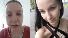 Hororový zubař v Teplicích! Žena má po zákroku zničené zuby i dásně
