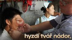 "Hrošímu muži" hyzdí tvář nádor, pomoci by mu měla operace