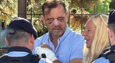 Šokující fotky Jaromíra Soukupa. Po rvačce s Dopitou má úplně rozbitý obličej