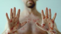 Evropou se šíří nebezpečná nemoc. Několik případů se objevilo i v Česku