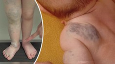 Nová léčba genetické mutace. Na nemoc zabírají léky proti rakovině