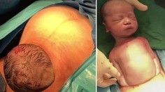 Zázrak zrození v přímém přenosu: Miminko samo vylezlo z břicha!