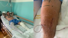 Smolař Kadlec je po další operaci. Tentokrát transplantaci chrupavky!