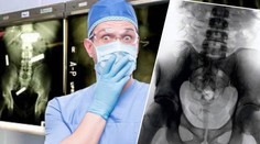 Šílená GALERIE: Tohle všechno už doktoři našli lidem v žaludku!