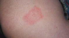 Největší epidemie svrabu v Česku za 30 let. Nemoc trápí nejvíce seniory a mladé