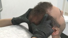 Lidé mají mnohem větší zájem o transplantaci vlasů. Nejlevněji vyjde v Turecku