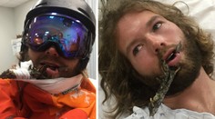 Piercing ze stromu! Lyžaři protla větev tvář a teď nemá na operaci