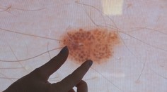 Rakoviny kůže přibývá. Češi podceňují ochranu před sluncem